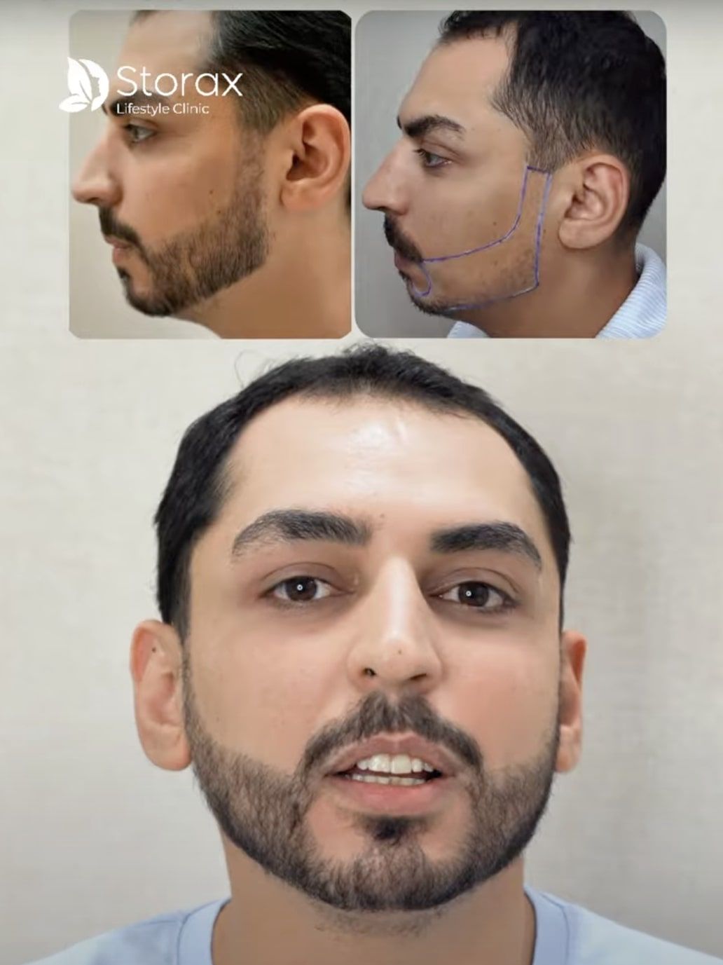 Beard Transplant in Dubai | Before & After Results