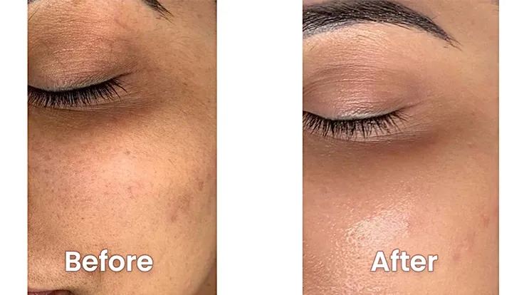 Face Peeling in Dubai