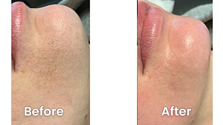 Face Peeling in Dubai