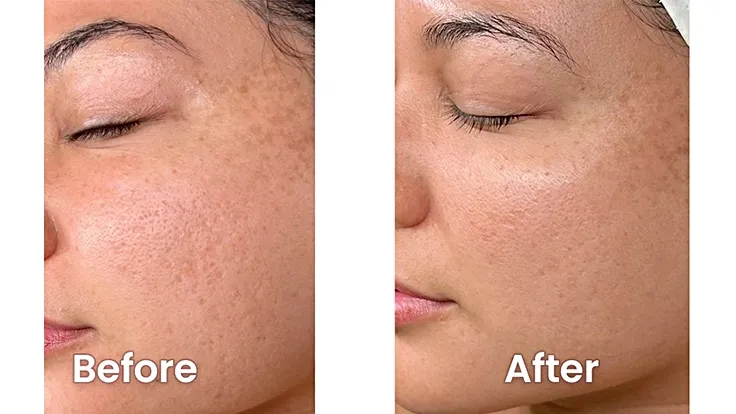 Face Peeling in Dubai