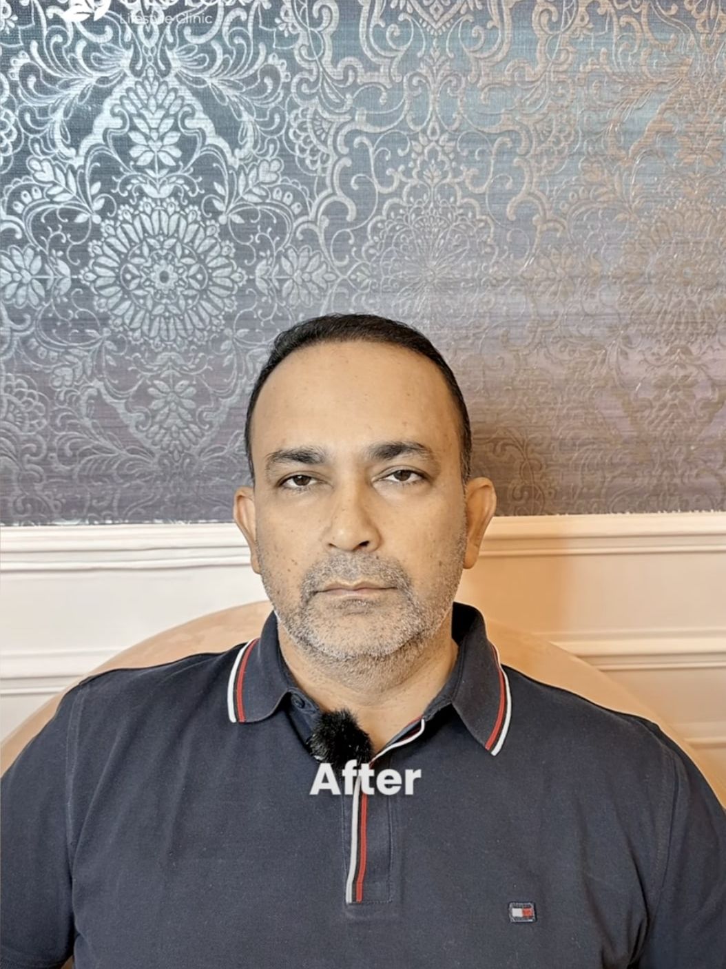 Best Hair Transplant Clinic in Dubai | Hair Transplant Before After Results