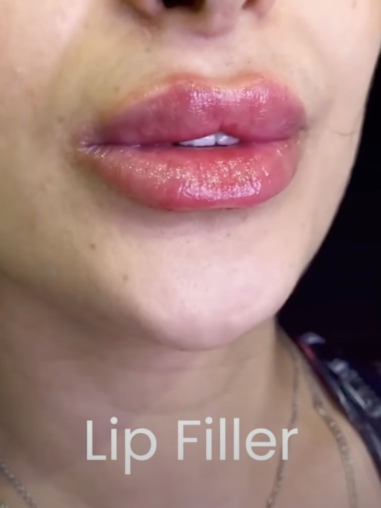 Confidence, Redefined | Discover the Power of Dermal Fillers in Dubai