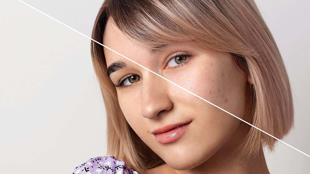 Skin Treatment in Dubai