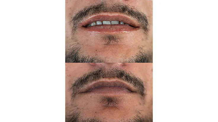 Laser treatment in Dubau