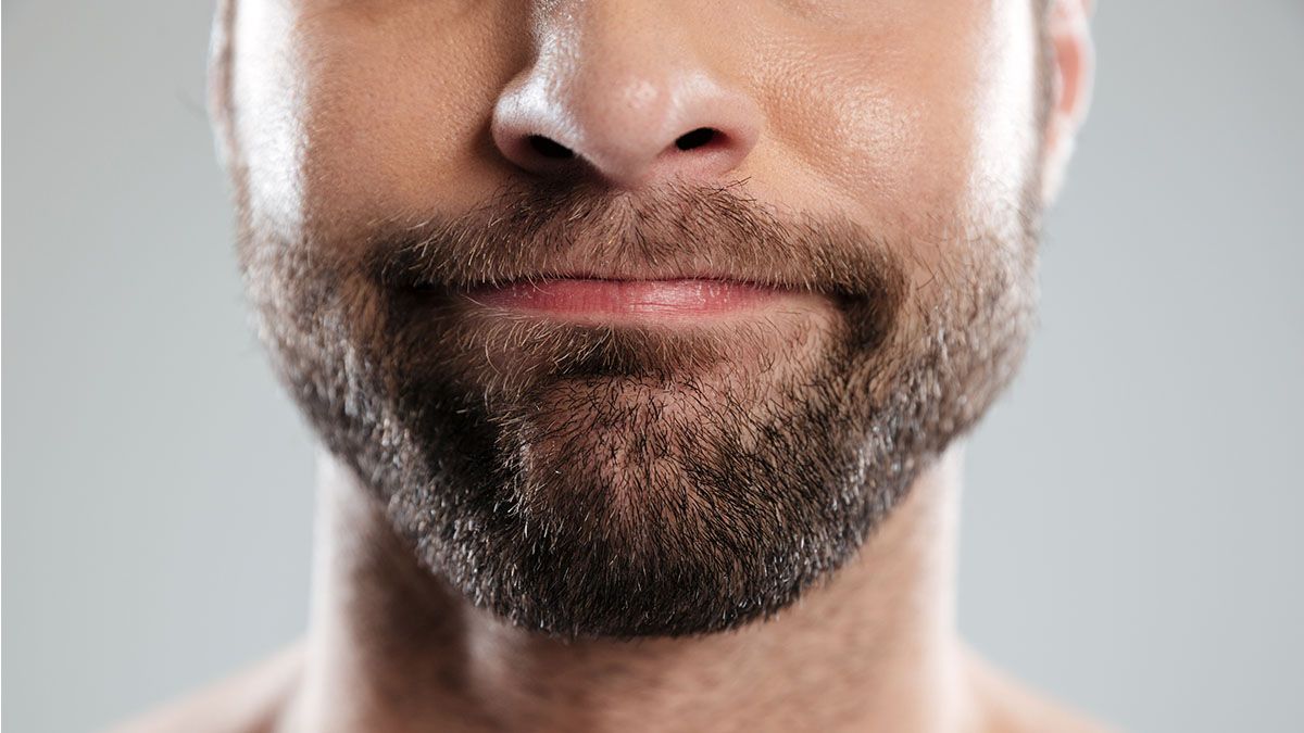 Beard Transplant 2