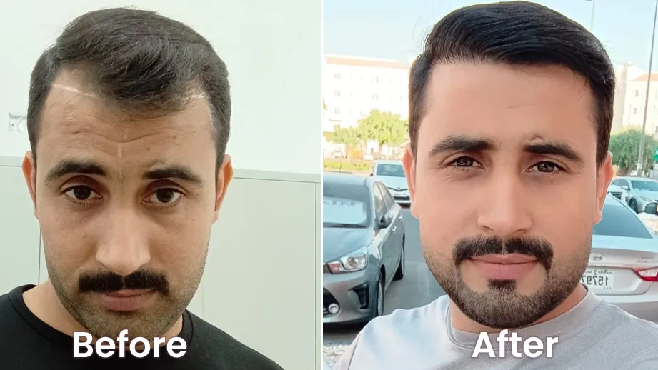 Hair Transplant in Dubai