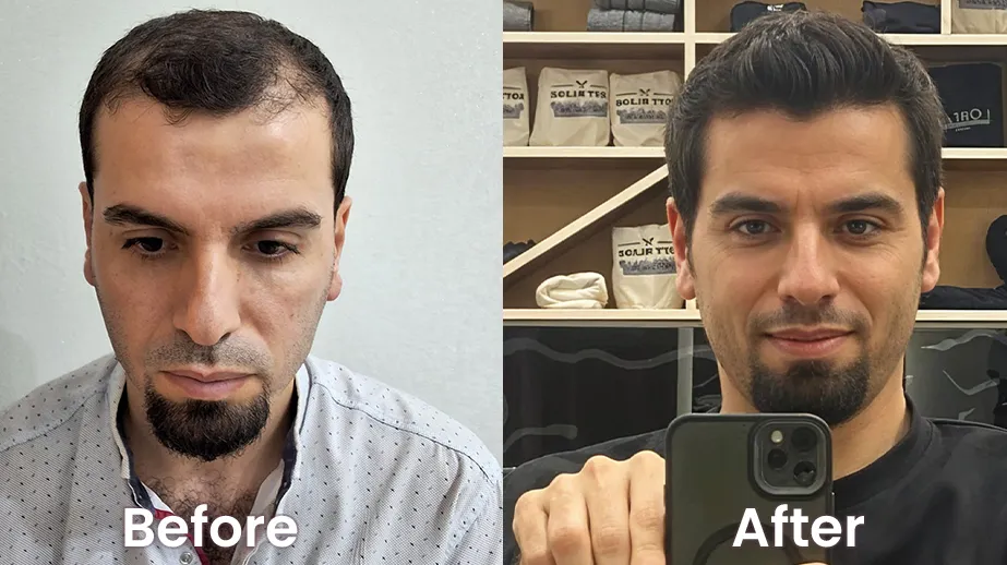 Hair Transplant in Dubai