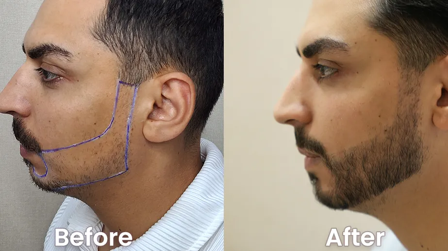 Hair Transplant in Dubai