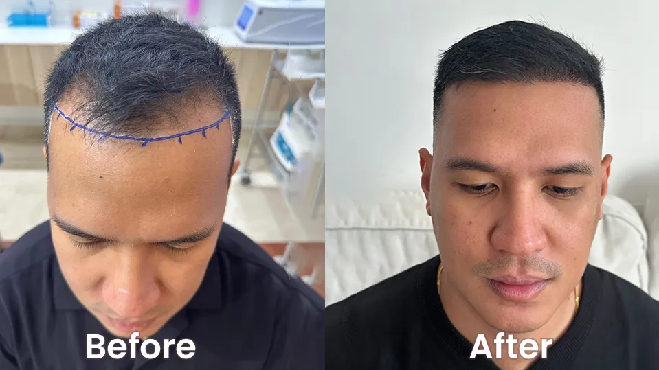 Hair Transplant in Dubai