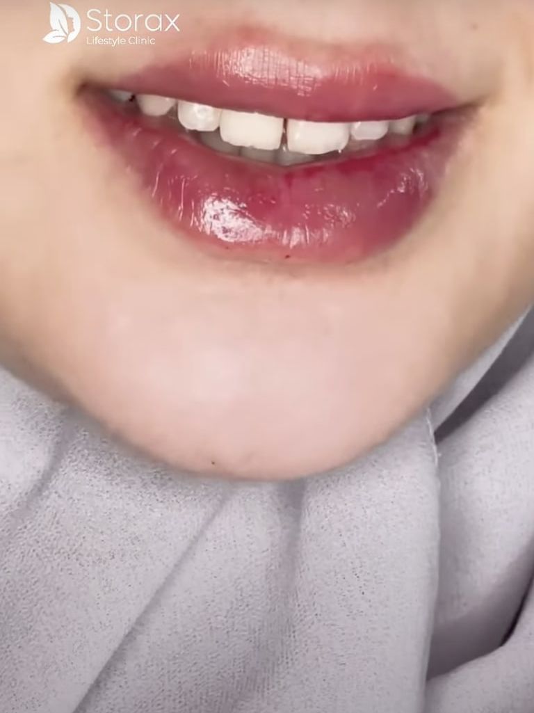 Lip Fillers in Dubai: Where to Get the Perfect, Natural-Looking Lips