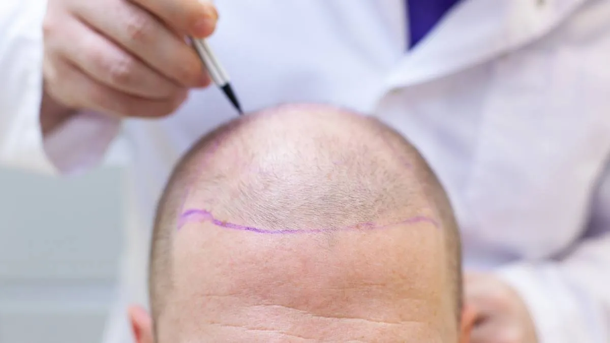 Hair Transplant Dubai vs. Turkey: Why Dubai is the Better Choice