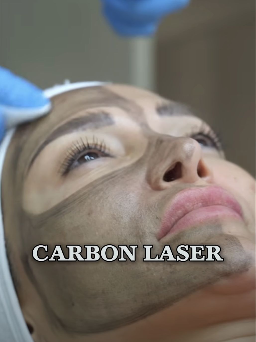Carbon Laser Face Rejuvenation in Dubai
