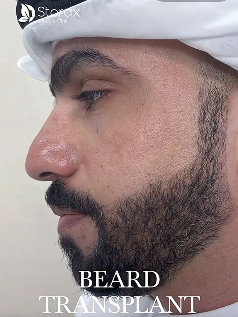 Achieve a Fuller Beard with Expert Care in Dubai