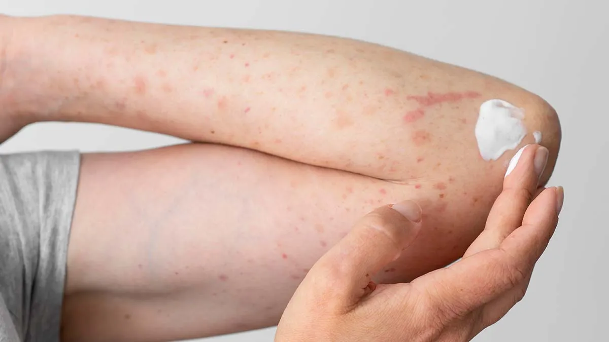 Keratosis Pilaris Treatment in Dubai