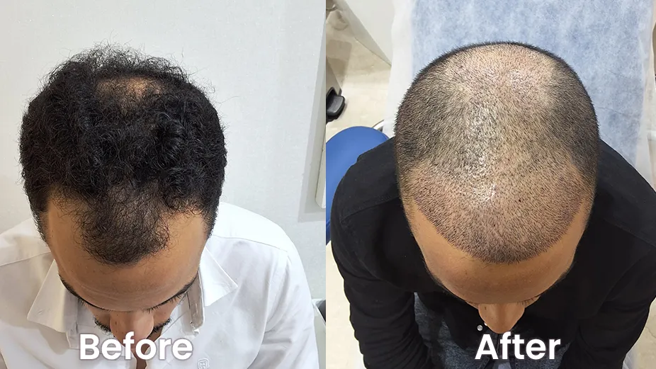 Hair Transplant in Dubai