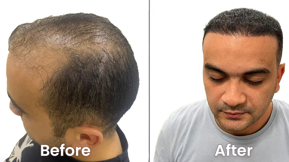Hair Transplant in Dubai