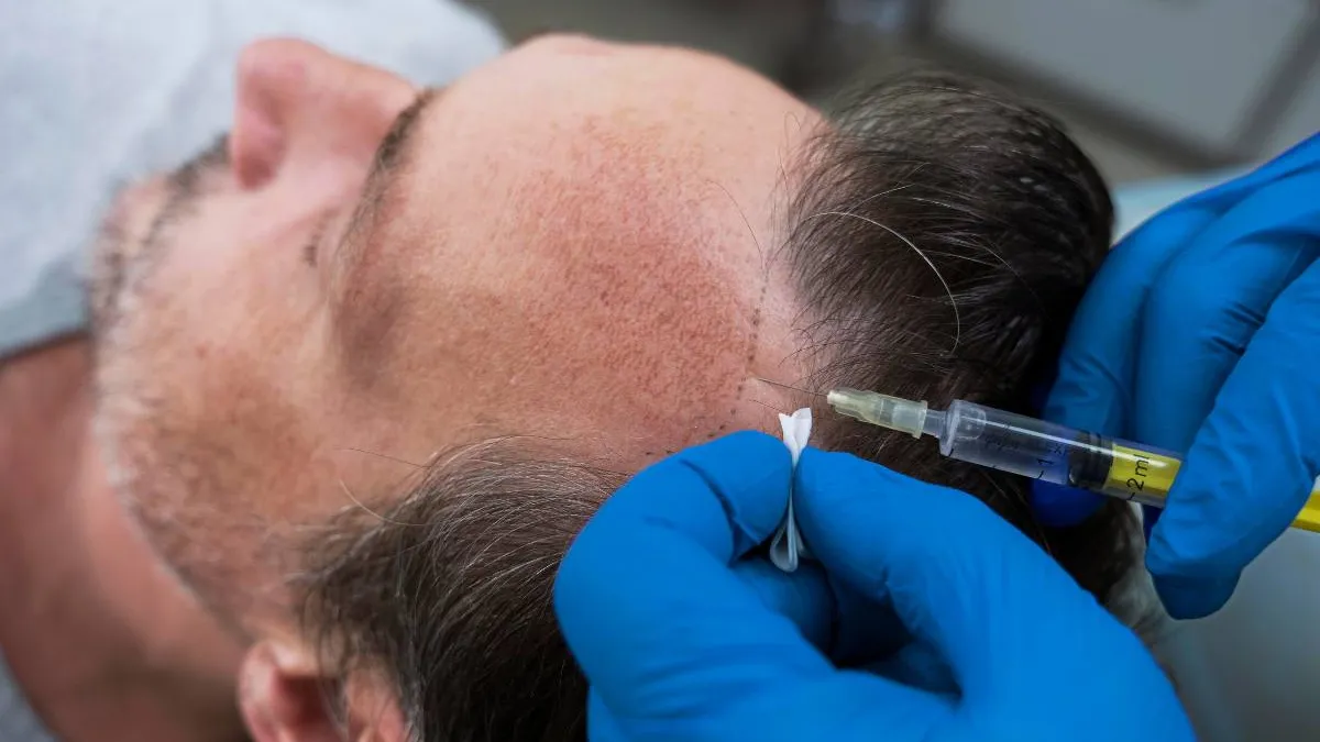 Latest Hair Restoration Techniques