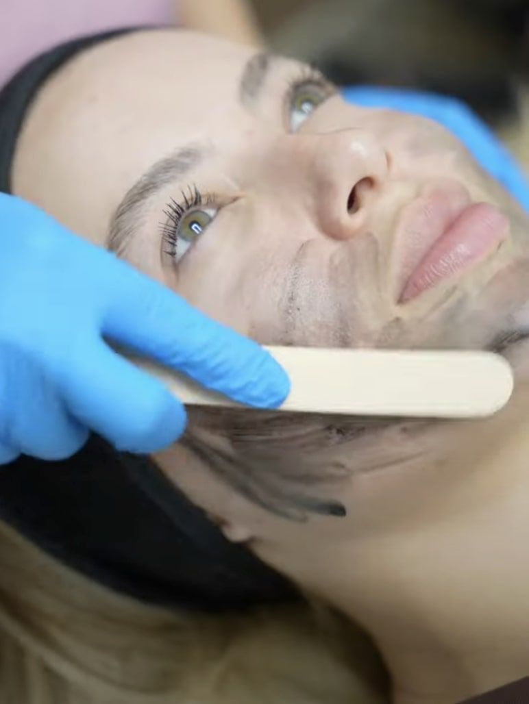 Carbon Laser Facial in Dubai | Deep Cleansing & Instant Glow