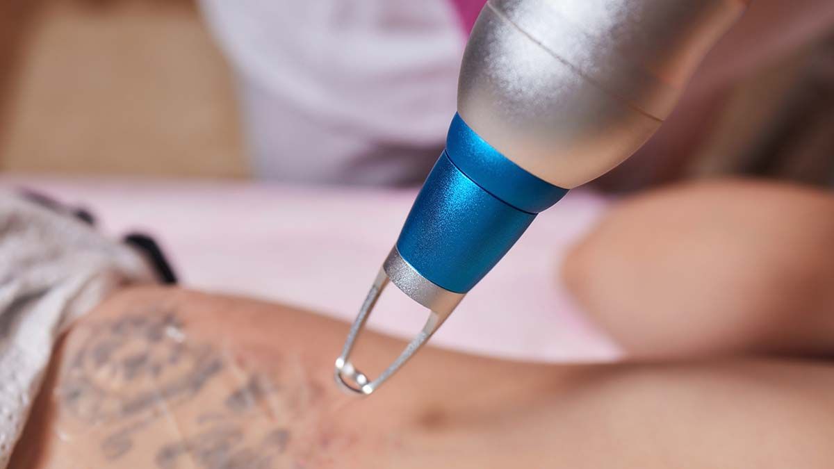 Tattoo Removal in Dubai