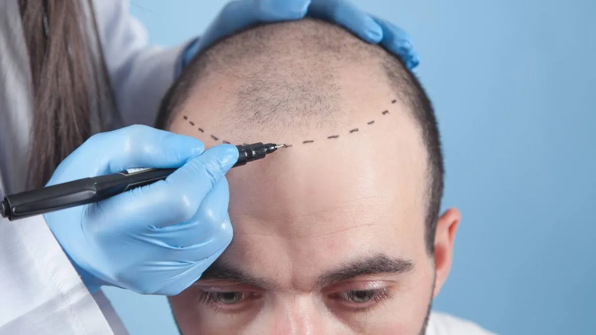 Fue Hair Transplant Blog