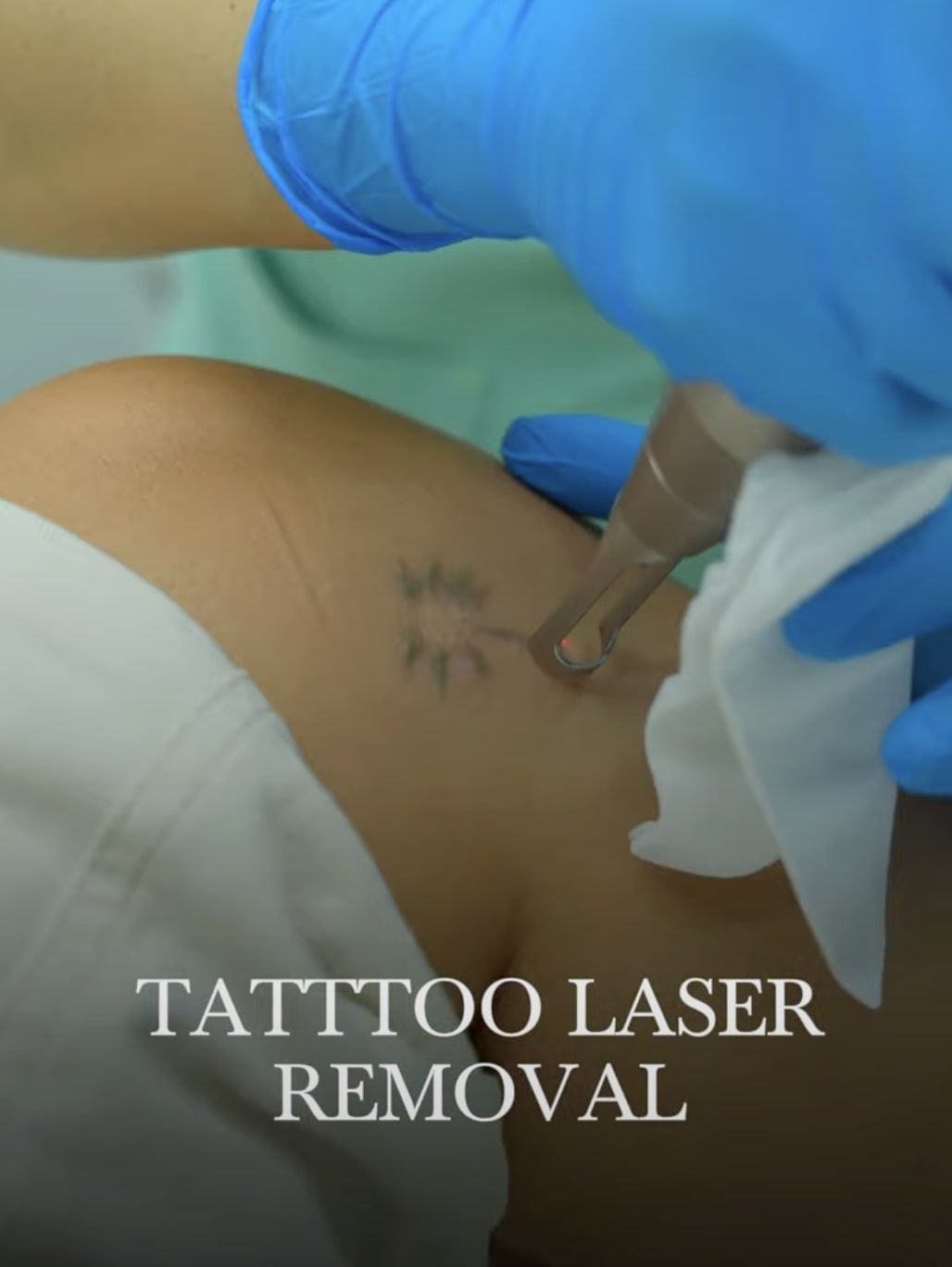 Laser Tattoo Removal in Dubai | Before & After