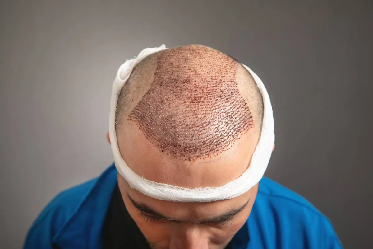 Hair Transplant Cost in the UAE