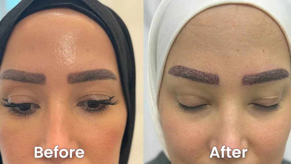 Hair Transplant in Dubai