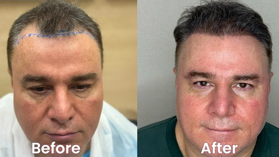 Hair Transplant in Dubai